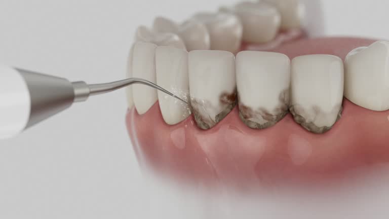 Trusted Wisdom Tooth Removal service in Bell Gardens, CA - Dentist Open Now